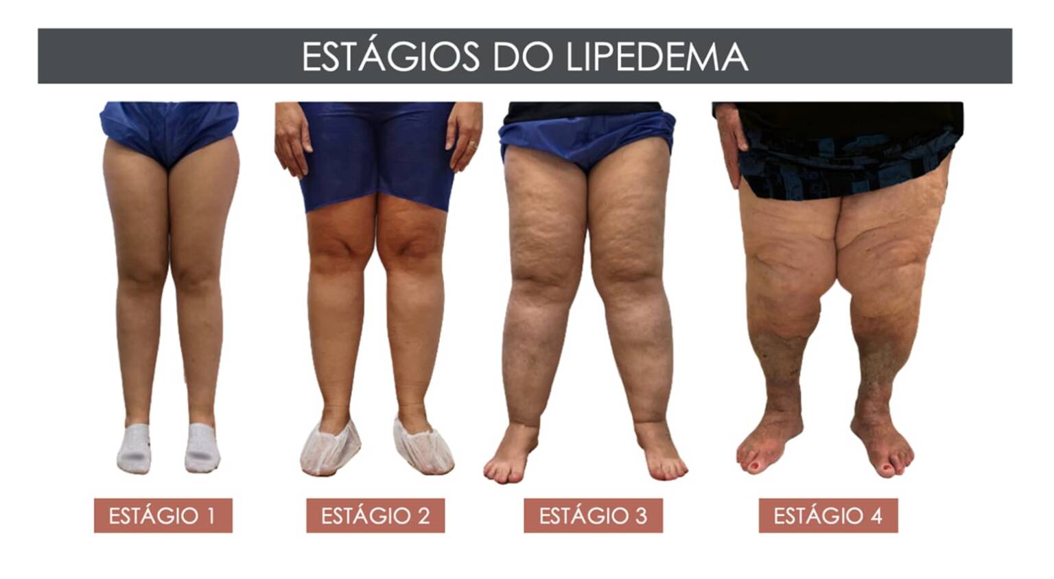Lipedema Dra Mariana Barros lipedema-dra-mariana-barros
